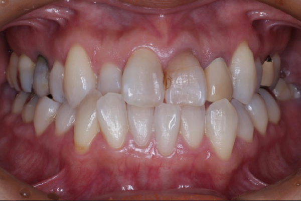 全顎治療の症例3-1