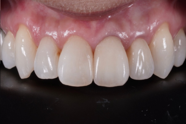 全顎治療の症例3-2