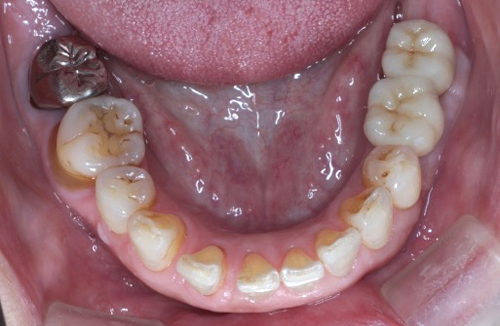 矯正治療の症例5-2