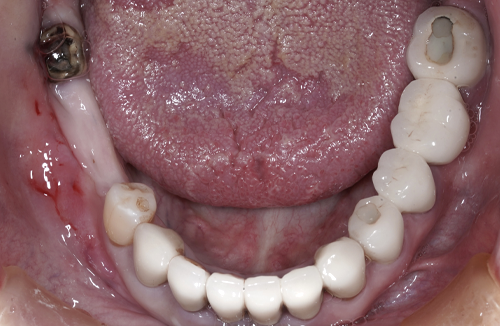 矯正治療の症例5-1