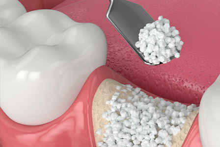 骨造成治療について