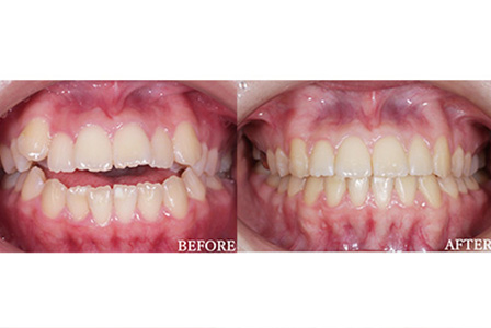 札幌の矯正で荒川デンタルクリニックが選ばれる理由