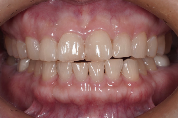 矯正治療の症例15-1