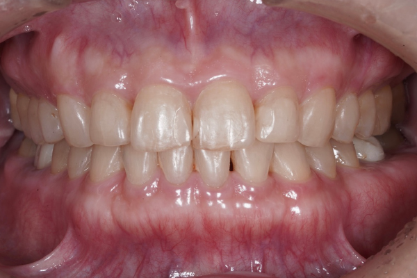 矯正治療の症例15-2