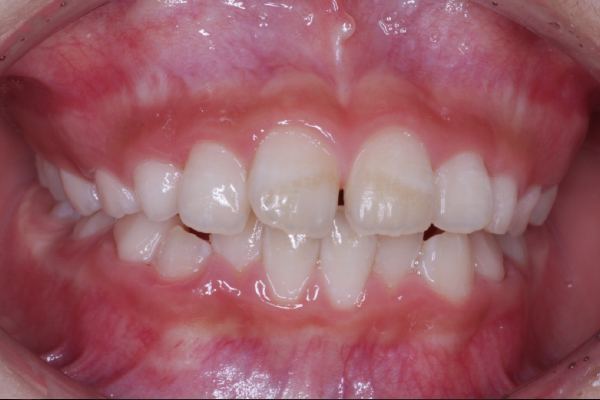 矯正治療の症例15-1