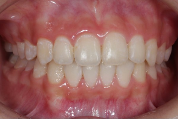 矯正治療の症例15-2