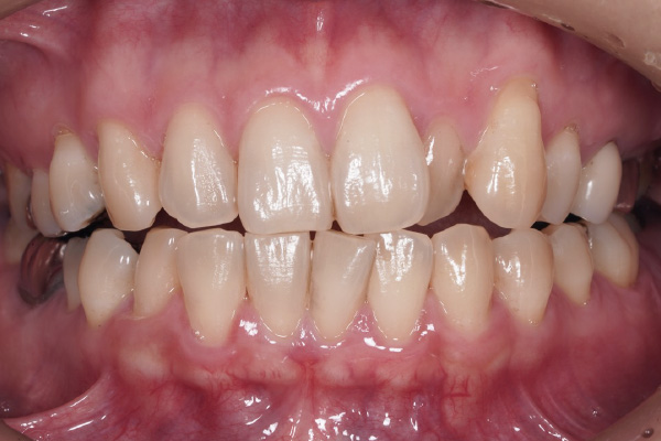 矯正治療の症例8-1