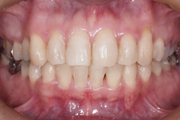 矯正治療の症例8-2