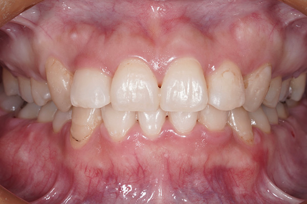 矯正治療の症例1-2