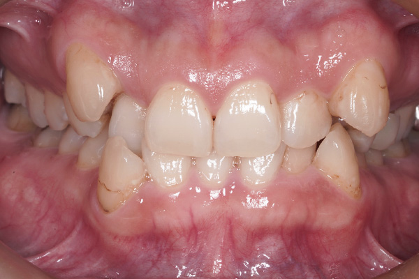 矯正治療の症例1-1